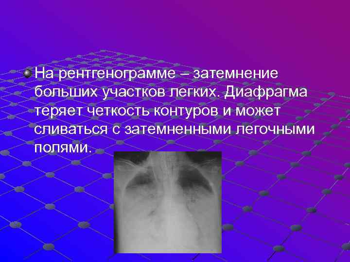 На рентгенограмме – затемнение больших участков легких. Диафрагма теряет четкость контуров и может сливаться