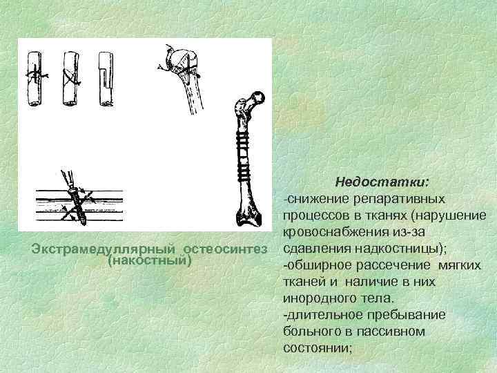 Экстрамедуллярный остеосинтез (накостный) Недостатки: -снижение репаративных процессов в тканях (нарушение кровоснабжения из-за сдавления надкостницы);