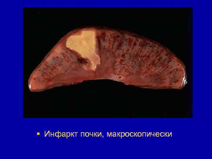 § Инфаркт почки, макроскопически 