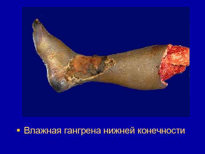 § Влажная гангрена нижней конечности 