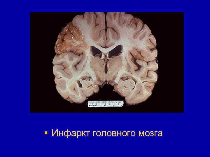 Фото инфаркт мозга