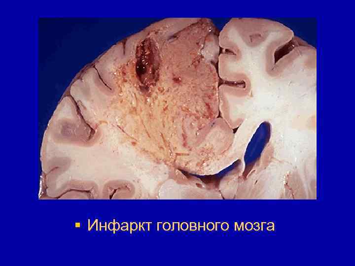 § Инфаркт головного мозга 