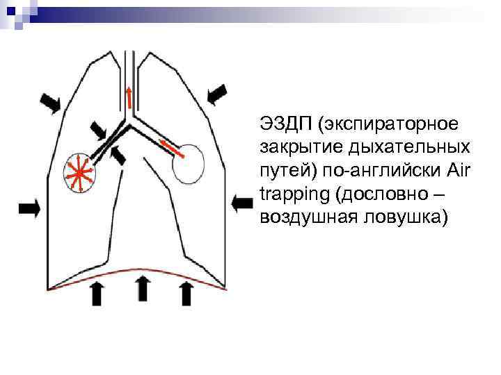 ЭЗДП (экспираторное закрытие дыхательных путей) по-английски Air trapping (дословно – воздушная ловушка) 