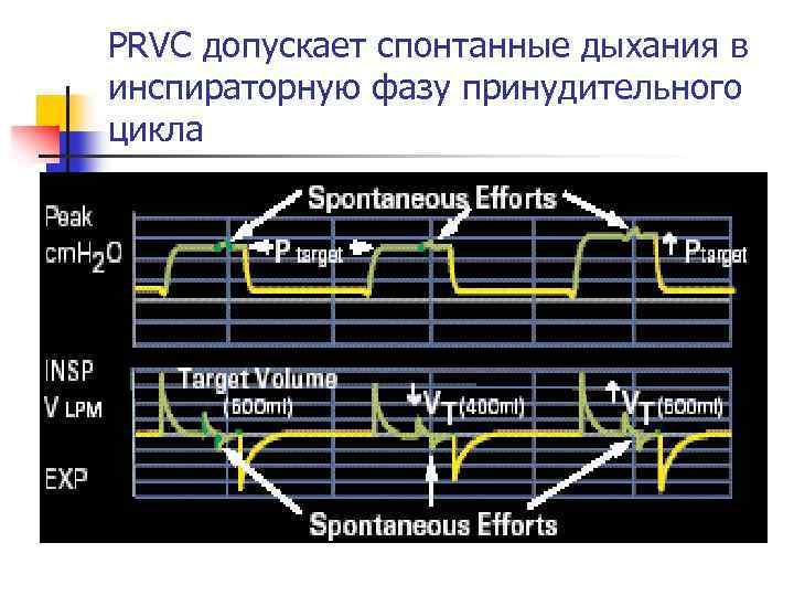 PRVC допускает спонтанные дыхания в инспираторную фазу принудительного цикла 