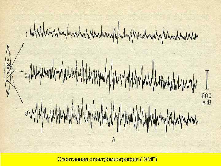 Спонтанная электромиография ( ЭМГ) 
