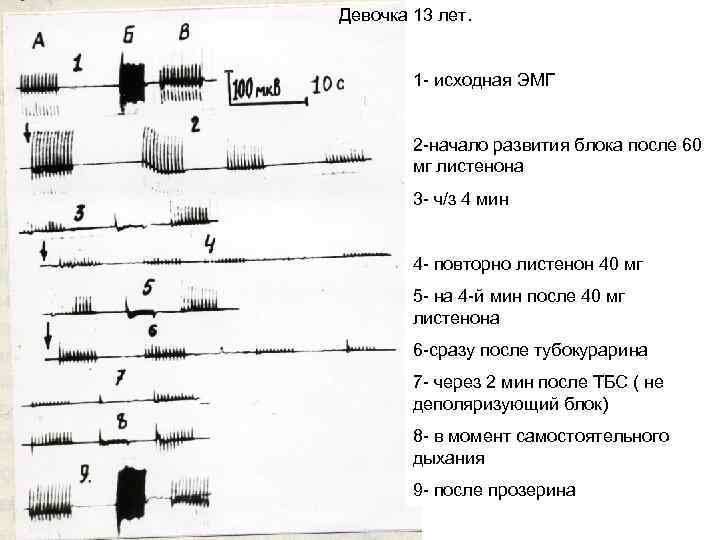 Девочка 13 лет. 1 - исходная ЭМГ 2 -начало развития блока после 60 мг