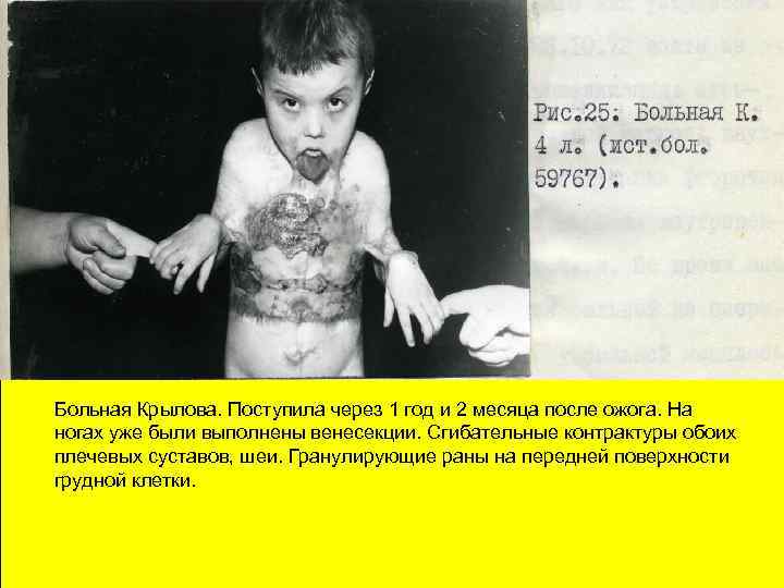 Больная Крылова. Поступила через 1 год и 2 месяца после ожога. На ногах уже