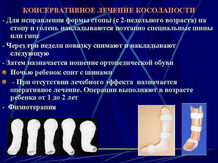 КОНСЕРВАТИВНОЕ ЛЕЧЕНИЕ КОСОЛАПОСТИ - Для исправления формы стопы (с 2 -недельного возраста) на стопу