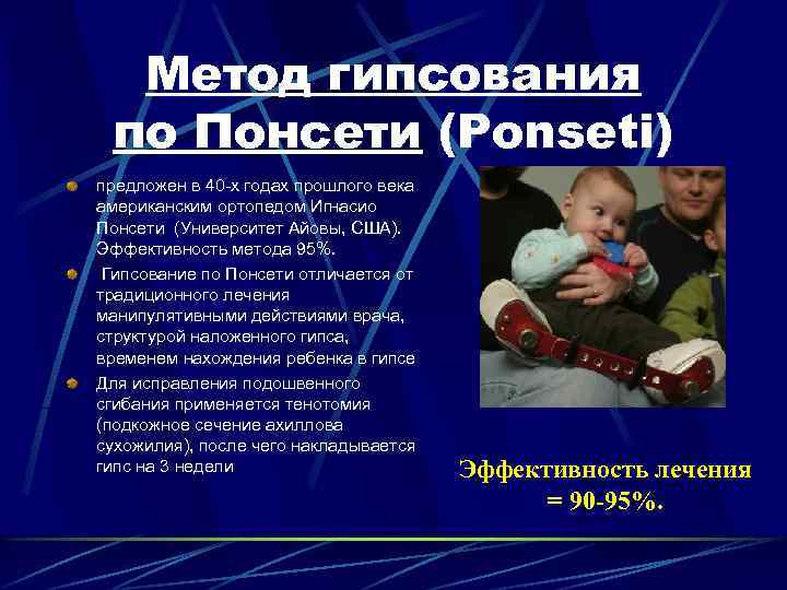 Метод гипсования по Понсети (Ponseti) предложен в 40 -х годах прошлого века американским ортопедом