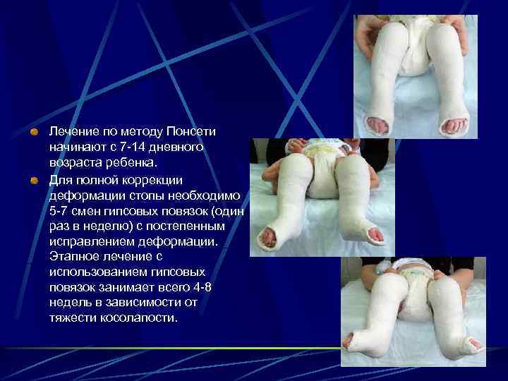 Лечение по методу Понсети начинают с 7 -14 дневного возраста ребенка. Для полной коррекции