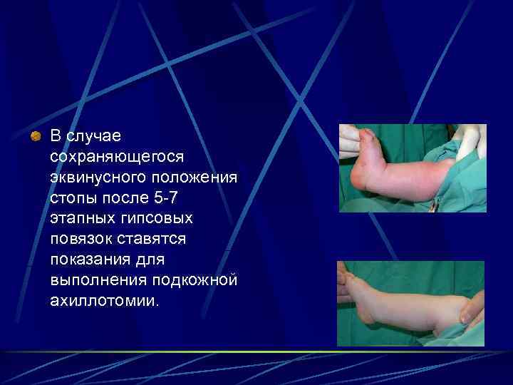 Эквинусная установка стопы. Эквинусная деформация стопы рентген. Эквиноварусная деформация стопы. Рентген эквинусной деформации стопы. Эквинусная установка стопы.