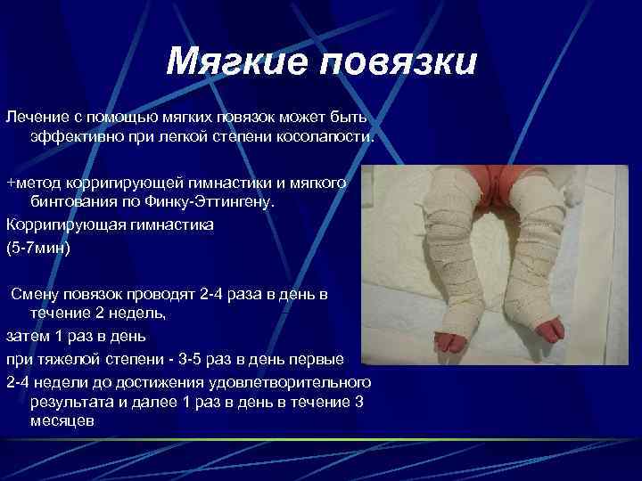 Мягкие повязки Лечение с помощью мягких повязок может быть эффективно при легкой степени косолапости.