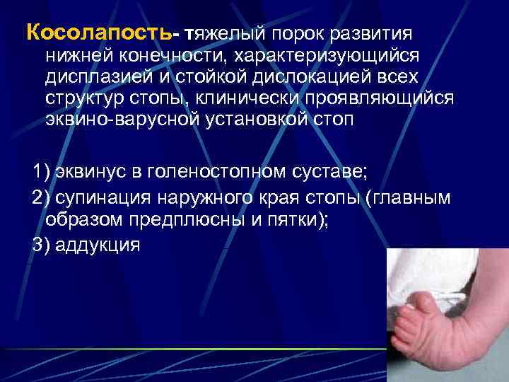 Косолапость- тяжелый порок развития нижней конечности, характеризующийся дисплазией и стойкой дислокацией всех структур стопы,