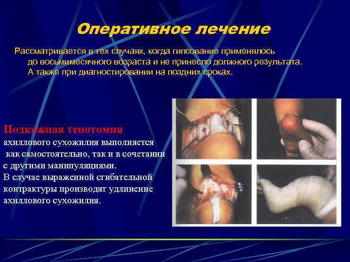 Оперативное лечение Рассматривается в тех случаях, когда гипсование применялось до восьмимесячного возраста и не