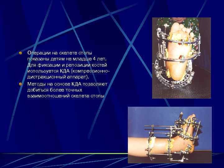 Операции на скелете стопы показаны детям не младше 4 лет. Для фиксации и репозиции