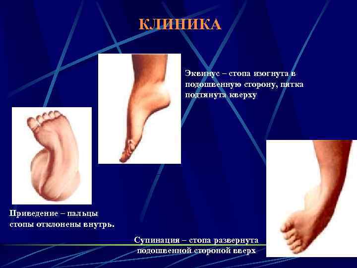 КЛИНИКА Эквинус – стопа изогнута в подошвенную сторону, пятка подтянута кверху Приведение – пальцы