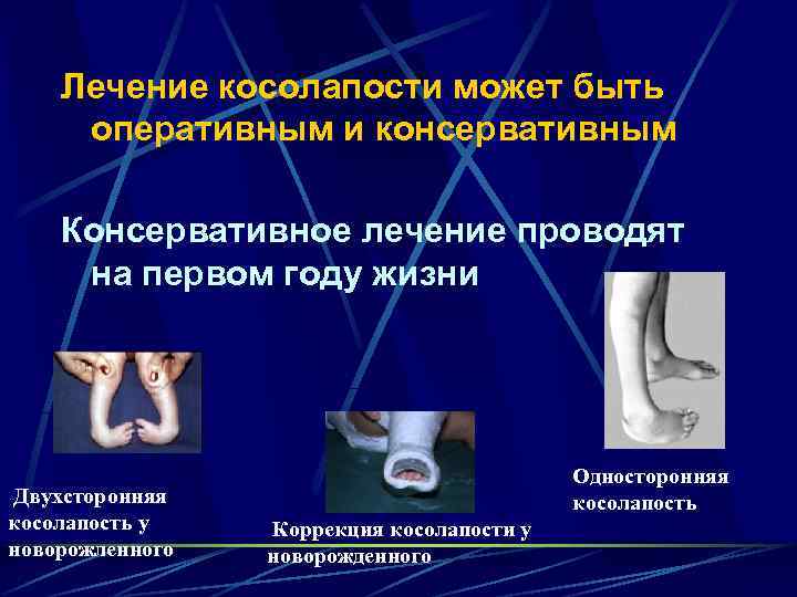 Лечение косолапости может быть оперативным и консервативным Консервативное лечение проводят на первом году жизни
