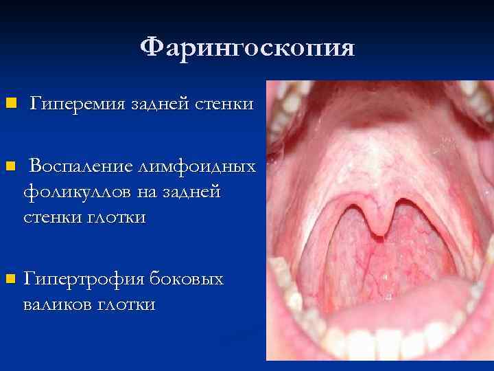  Фарингоскопия n Гиперемия задней стенки n Воспаление лимфоидных фоликуллов на задней стенки глотки