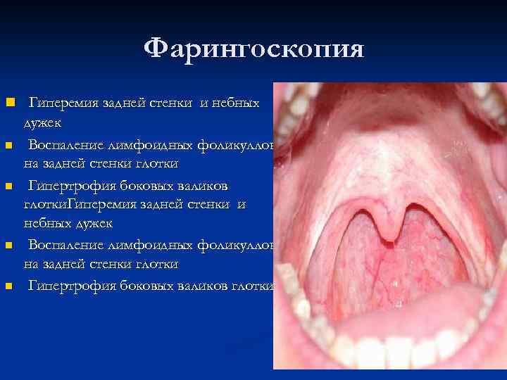  Фарингоскопия n Гиперемия задней стенки и небных дужек n Воспаление лимфоидных фоликуллов на