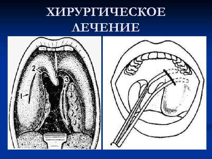 ХИРУРГИЧЕСКОЕ ЛЕЧЕНИЕ 