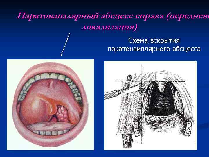 Паратонзиллярный абсцесс справа (передневе локализация) Схема вскрытия паратонзиллярного абсцесса 