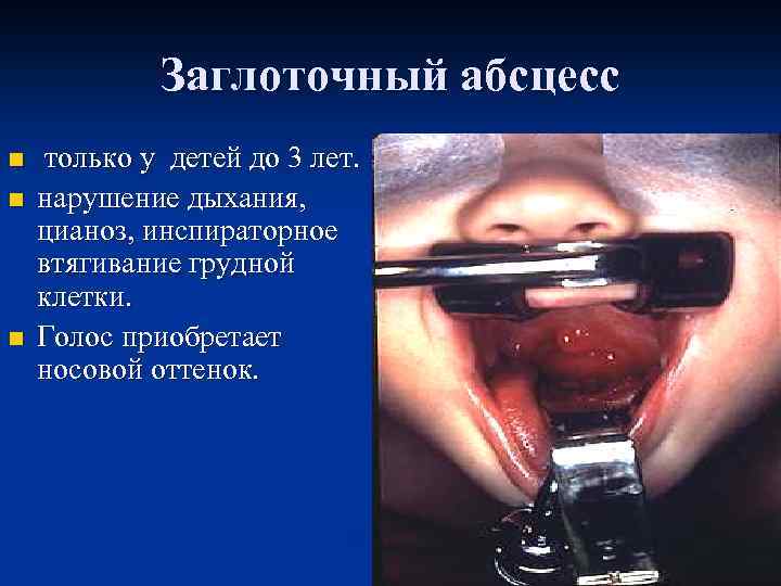  Заглоточный абсцесс n только у детей до 3 лет. n нарушение дыхания, цианоз,