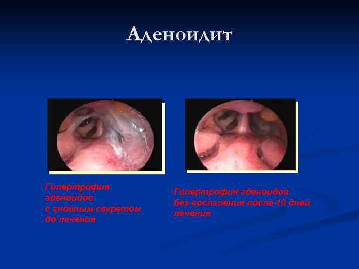  Аденоидит Гипертрофия Гипертрофия аденоидов без воспаления после 10 дней с гнойным секретом лечения