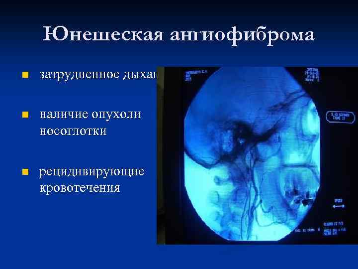  Юнешеская ангиофиброма n затрудненное дыхание n наличие опухоли носоглотки n рецидивирующие кровотечения 