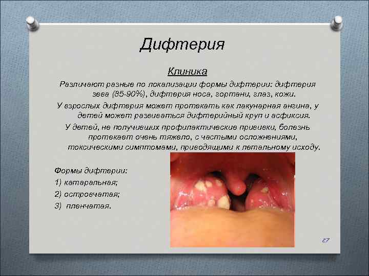 Дифтерия Клиника Различают разные по локализации формы дифтерии: дифтерия зева (85 -90%), дифтерия носа,