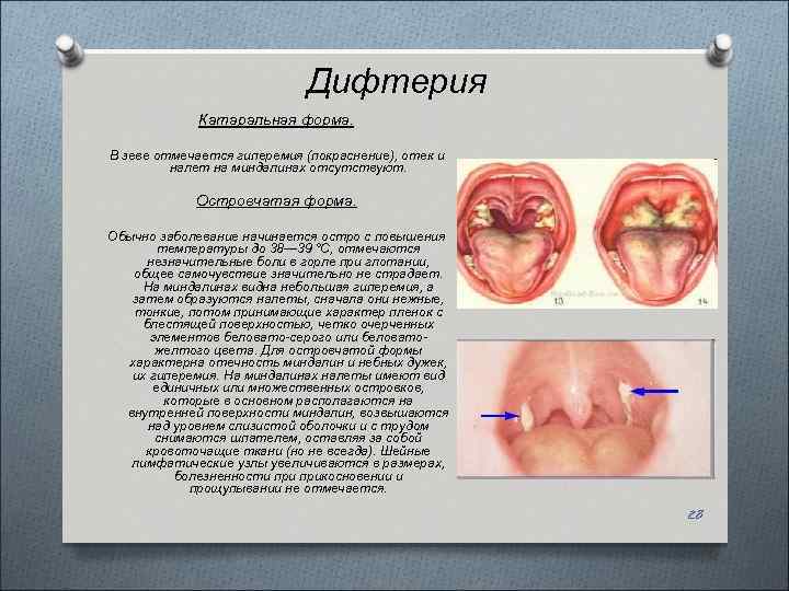 Дифтерия Катаральная форма. В зеве отмечается гиперемия (покраснение), отек и налет на миндалинах отсутствуют.