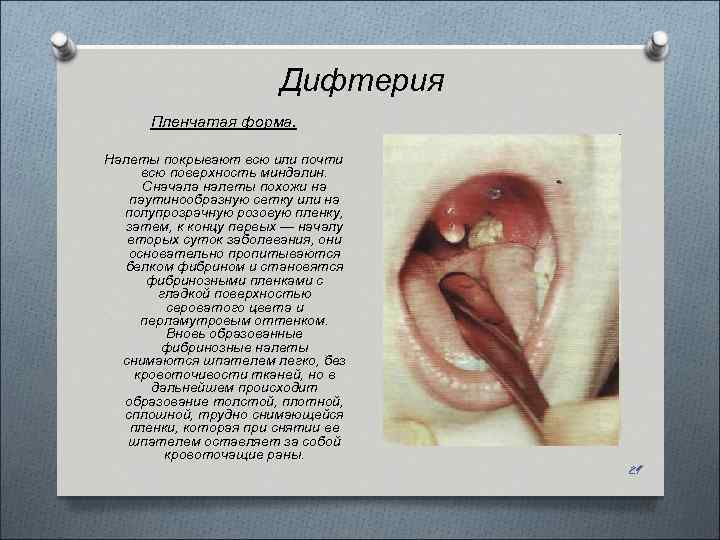 Дифтерия Пленчатая форма. Налеты покрывают всю или почти всю поверхность миндалин. Сначала налеты похожи