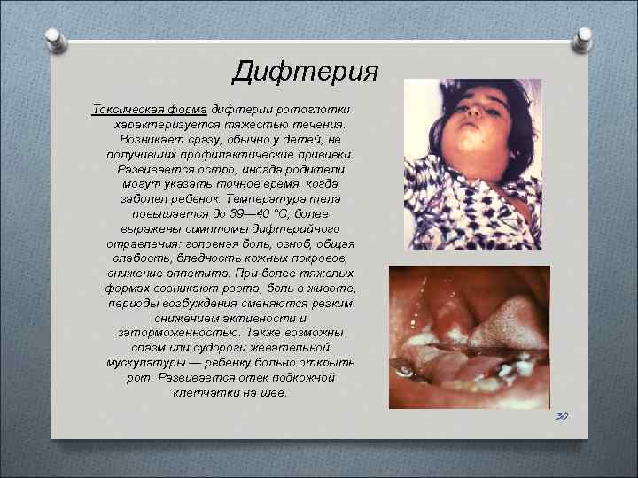Дифтерия Токсическая форма дифтерии ротоглотки характеризуется тяжестью течения. Возникает сразу, обычно у детей, не