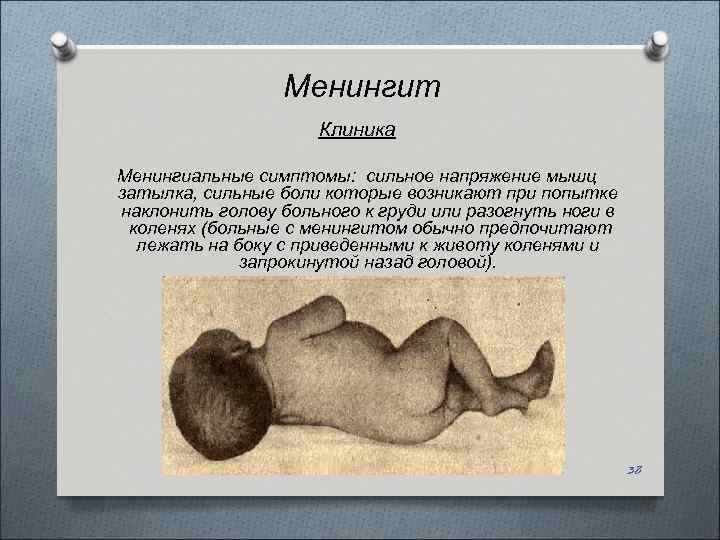 Менингит Клиника Менингиальные симптомы: сильное напряжение мышц затылка, сильные боли которые возникают при попытке