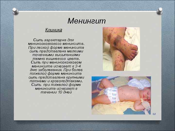 Менингит Клиника Сыпь характерна для менингококкового менингита. При легкой форме менингита сыпь представлена мелкими