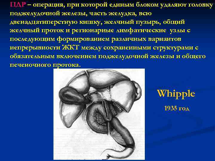 ПДР – операция, при которой единым блоком удаляют головку поджелудочной железы, часть желудка, всю