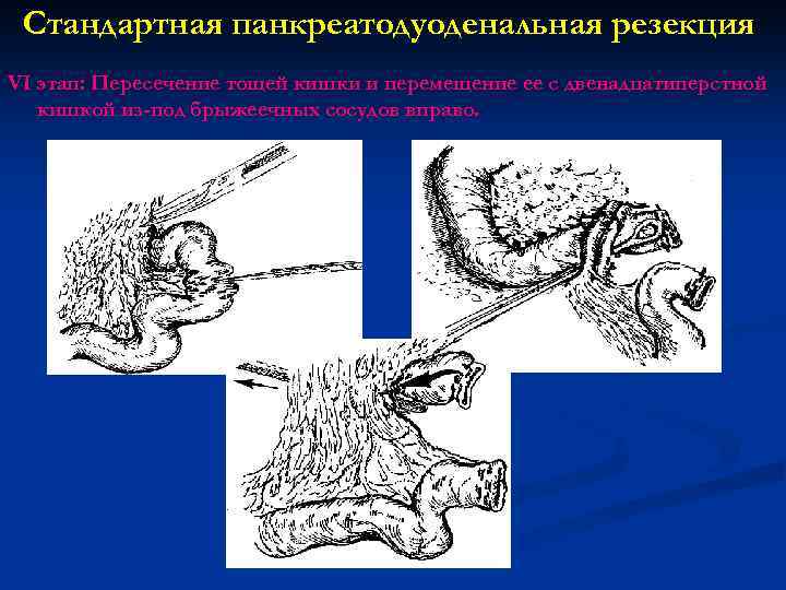 Стандартная панкреатодуоденальная резекция VI этап: Пересечение тощей кишки и перемещение ее с двенадцатиперстной кишкой