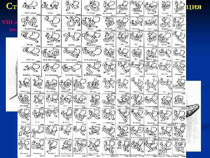 Стандартная панкреатодуоденальная резекция VIII этап: Восстановление непрерывности пищеварительного тракта с включением в него желчных