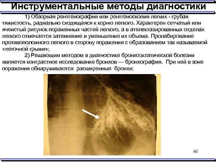 Инструментальные методы диагностики 1) Обзорная рентгенография или рентгеноскопия легких - грубая тяжистость, радиально сходящаяся