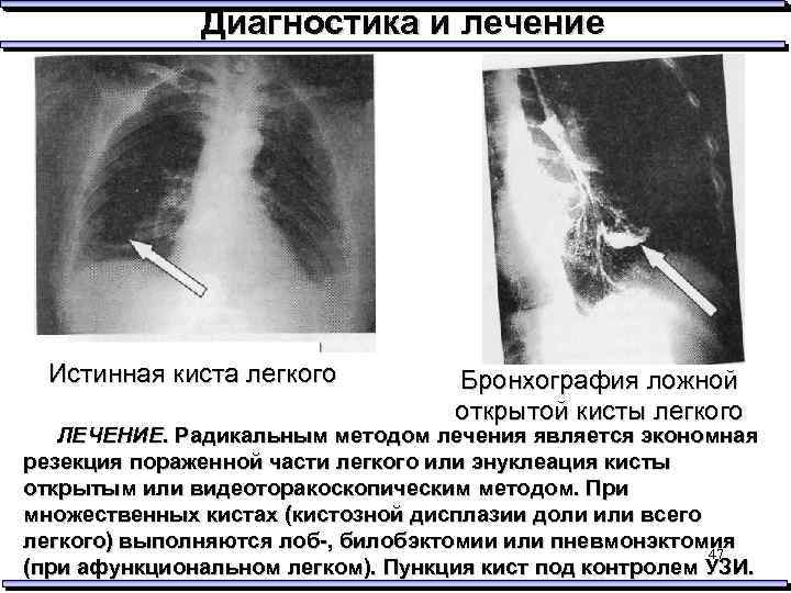 Диагностика и лечение Истинная киста легкого Бронхография ложной открытой кисты легкого ЛЕЧЕНИЕ. Радикальным методом