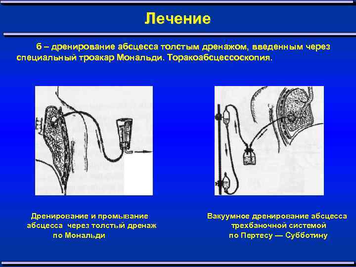 Дренирование