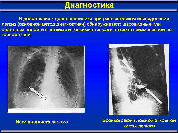 Диагностика В дополнение к данным клиники при рентгеновском исследовании легких (основной метод диагностики) обнаруживают:
