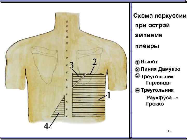 Тон шкоды при перкуссии