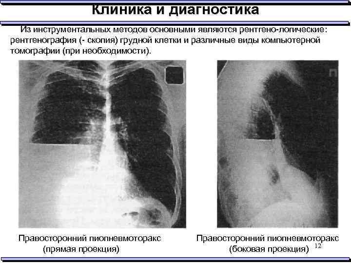 На рентгенологической картине напряженного пиопневмоторакса отмечается смещение средостения в