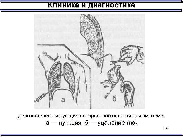 Разрыв плевры