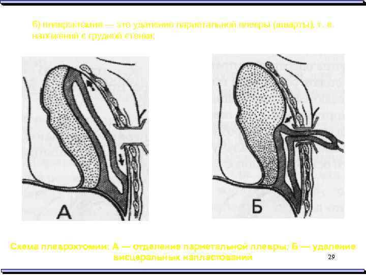 Плеврэктомия