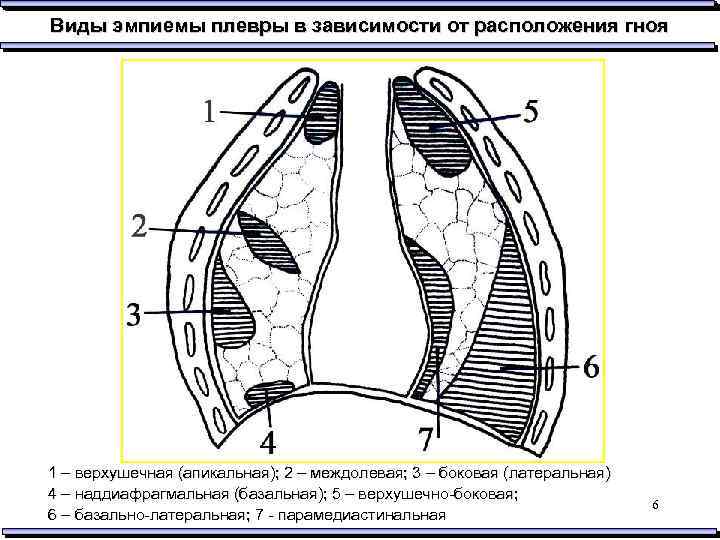 Эмпиема плевры хирургия презентация