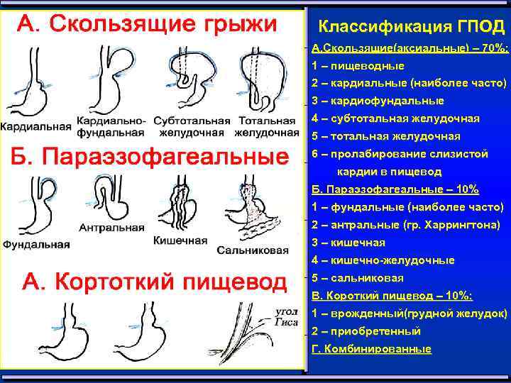 Классификация ГПОД А. Скользящие(аксиальные) – 70%: 1 – пищеводные 2 – кардиальные (наиболее часто)