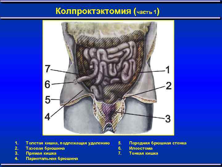 Колпроктэктомия (часть 1) 1. 2. 3. 4. Толстая кишка, подлежащая удалению Тазовая брюшина Прямая