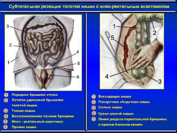 Субтотальная резекция толстой кишки с илео-ректальным анастомозом 1 Передняя брюшная стенка 2 Остатки удаленной