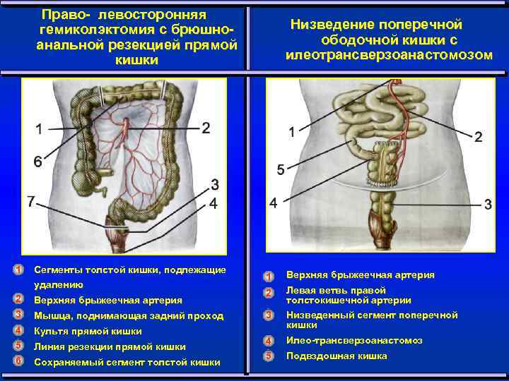 Право- левосторонняя гемиколэктомия с брюшноанальной резекцией прямой кишки 1 Сегменты толстой кишки, подлежащие удалению